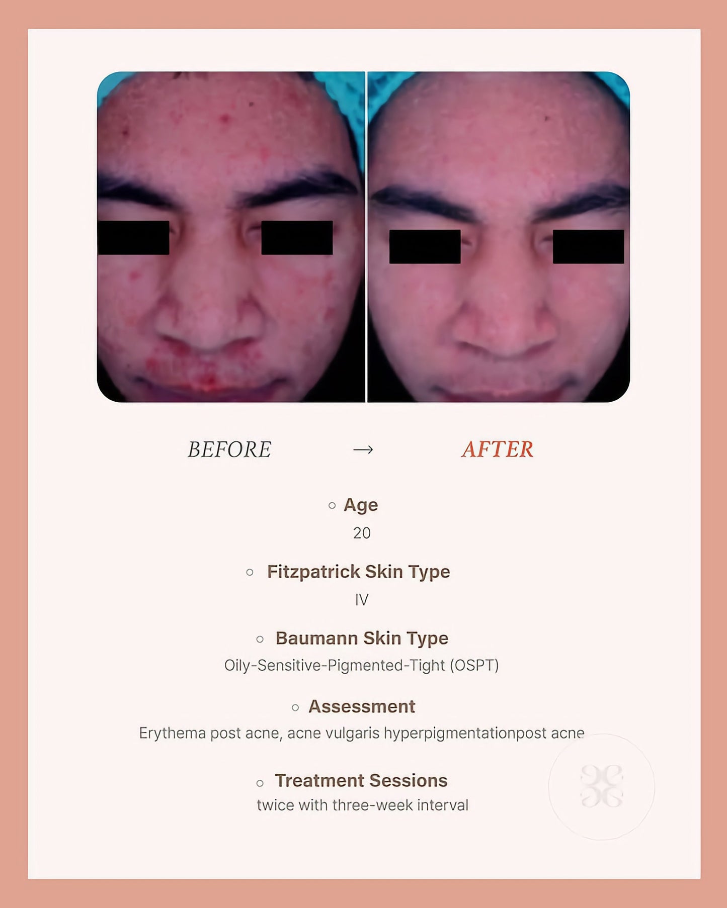 BLESKIN EXXO Exosome Skin Booster