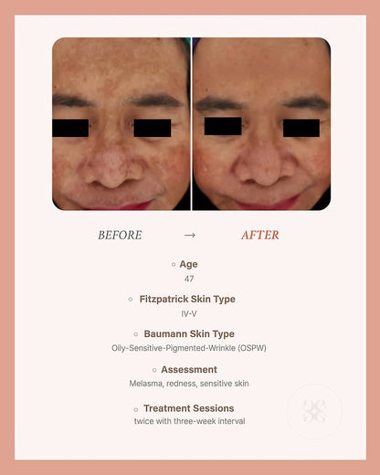 BLESKIN EXXO Exosome Skin Booster