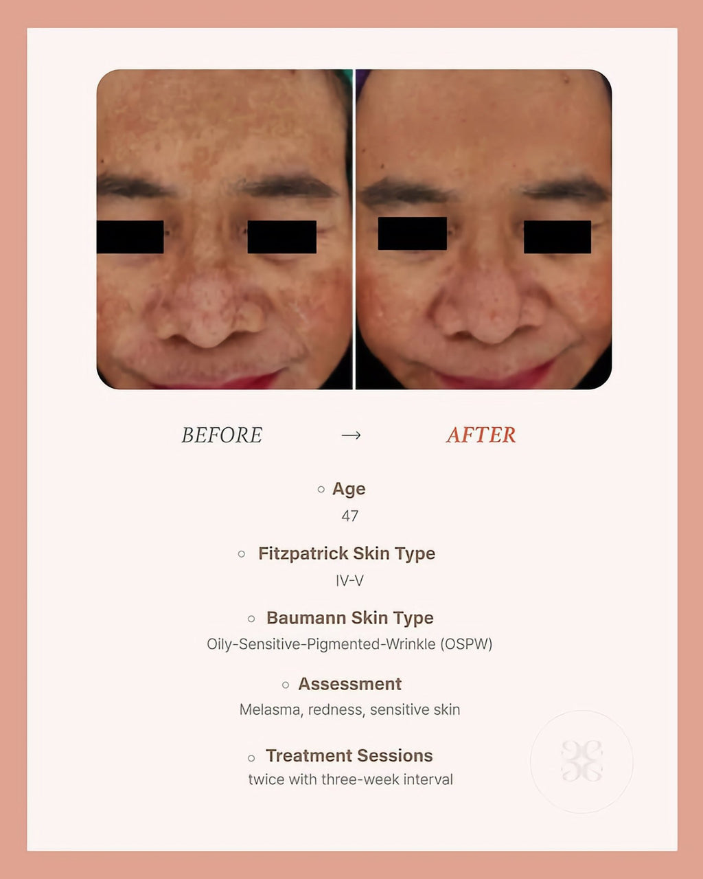 BLESKIN EXXO Exosome Skin Booster (5 treatments) - Glo Skin Beauty UK&I