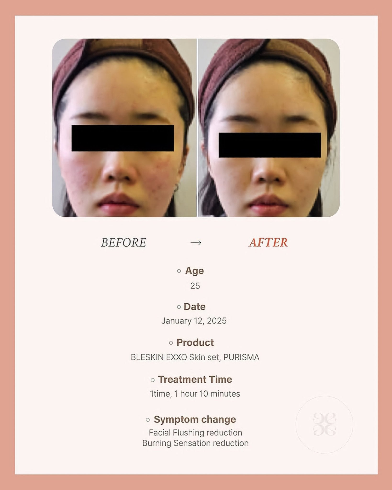 BLESKIN EXXO Exosome Skin Booster (5 treatments) - Glo Skin Beauty UK&I