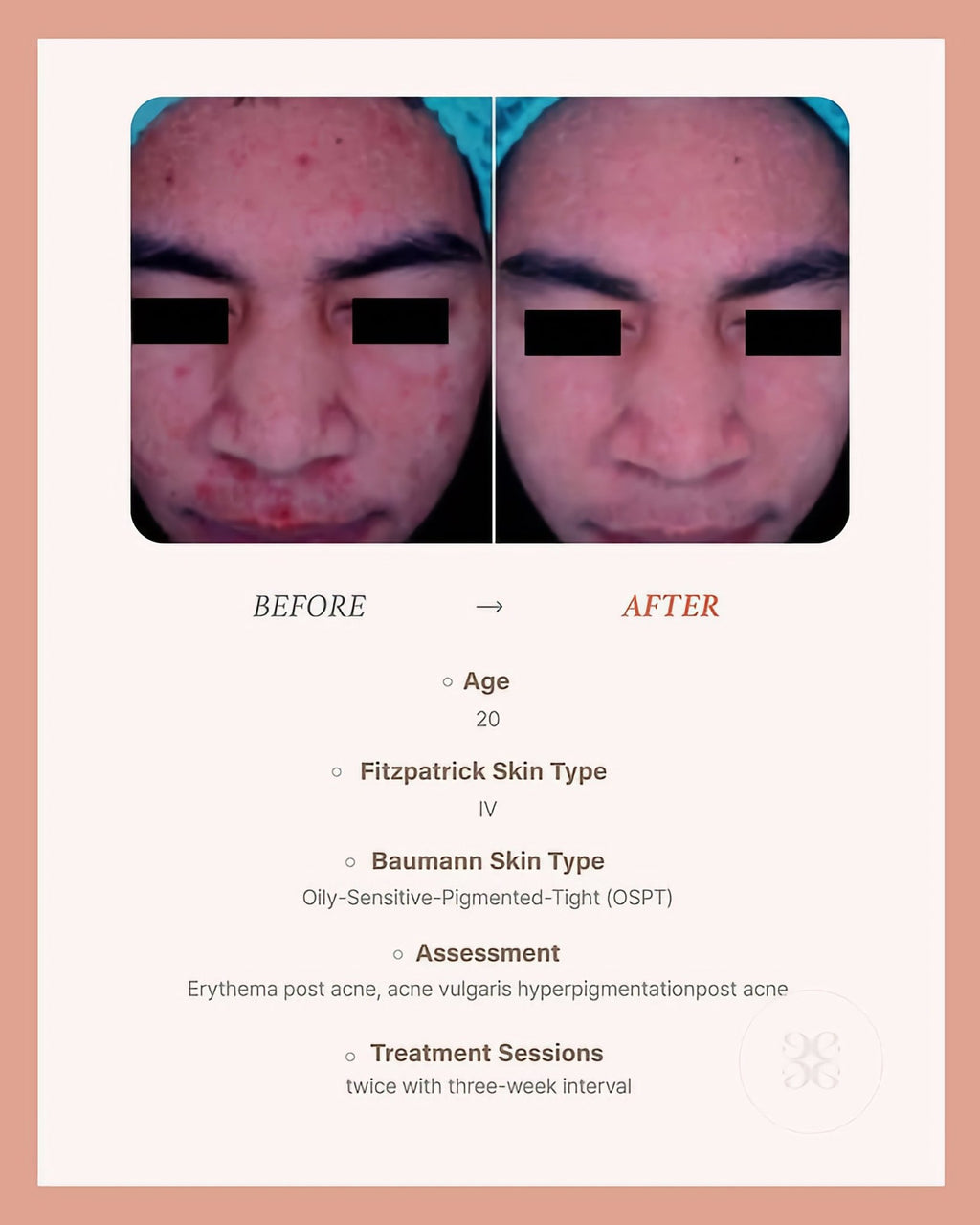 BLESKIN EXXO Exosome Skin Booster (5 treatments) - Glo Skin Beauty UK&I