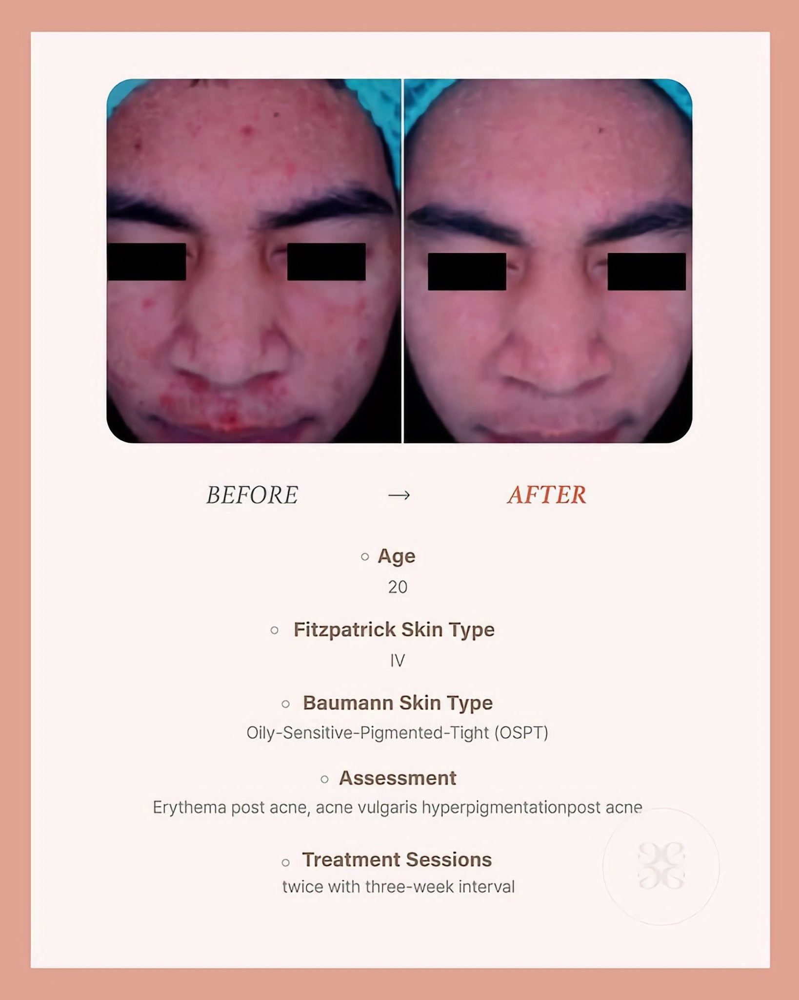 BLESKIN EXXO Exosome Skin Booster (5 treatments) - Glo Skin Beauty UK&I